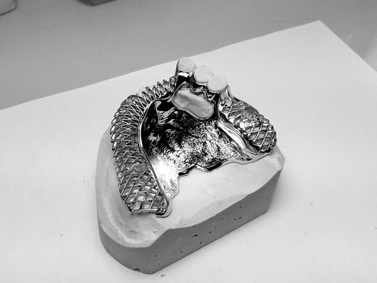 Châssis métallique (stellite) dentaire Laboratoire Simon N